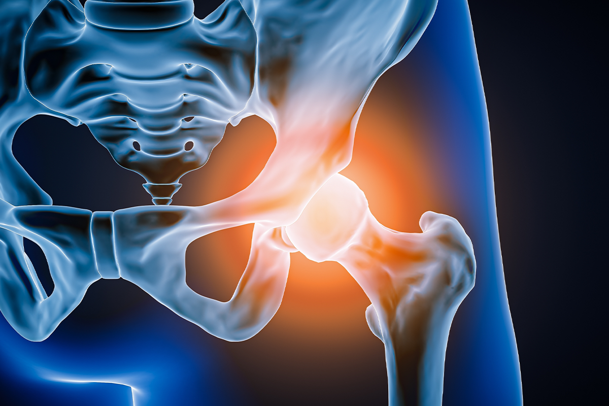 X-ray image of a hip injury